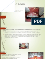 Absceso en Boca