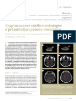 Cryptococcose Cérébro-Méningée À Présentation Pseudo-Vasculaire