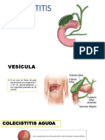 COLECISTITIS