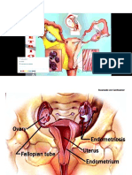 Tema. - Endometriosis Cáncer de Endometrio