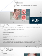 Laringitis: causas, síntomas y tratamiento de la inflamación de la laringe