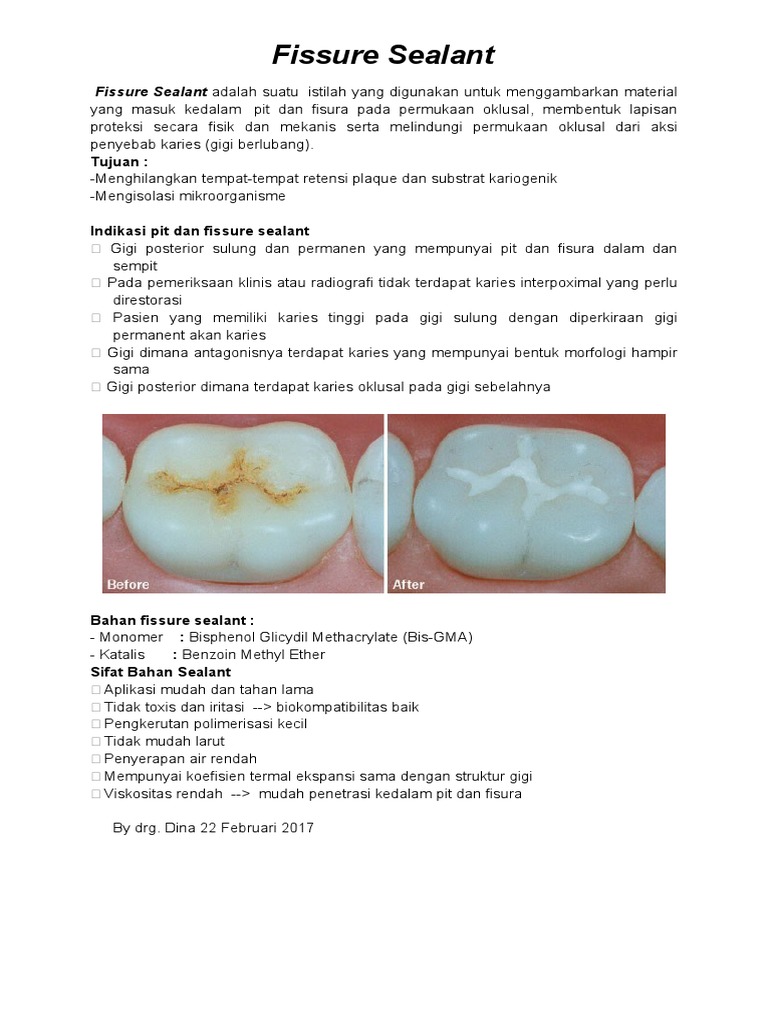 Protecting Tooth Surfaces from Decay PDF