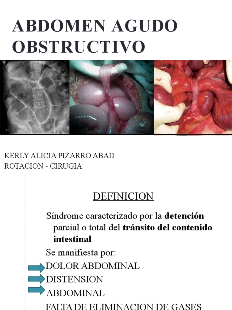 Abdomen Agudo Obstructivo PDF Cáncer colonrectal Intestino grueso