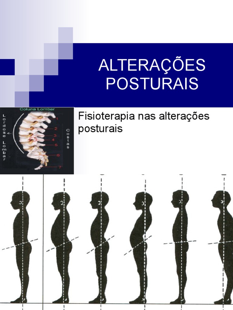 Hiperlordose Lombar | PDF | Medicina Clínica | Doenças e distúrbios