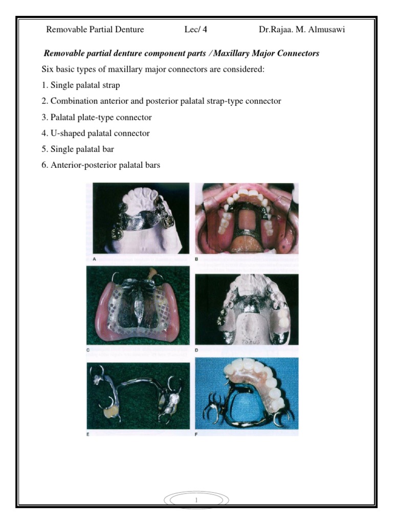 Types and Uses of Maxillary Major Connectors in Removable Partial Dentures PDF Dentistry