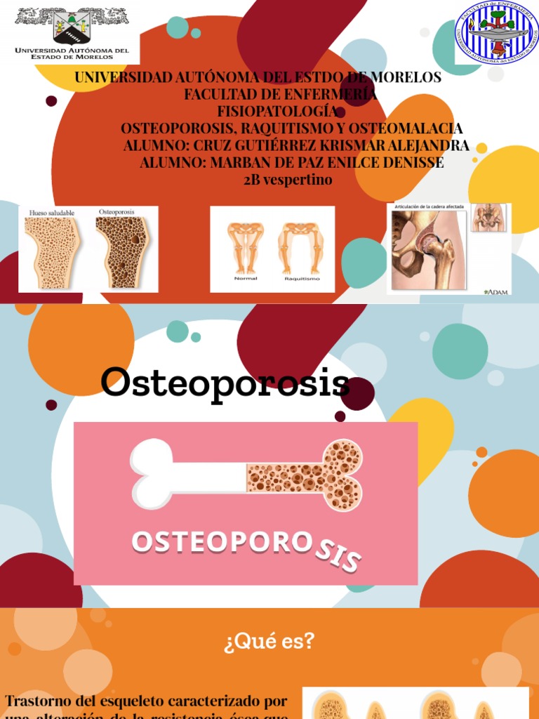 Raquitismo, Osteomalacia y Osteoporosis | PDF | Osteoporosis | Vitamina D