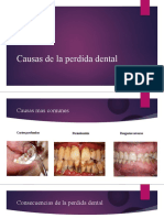 Causas de La Perdida Dental