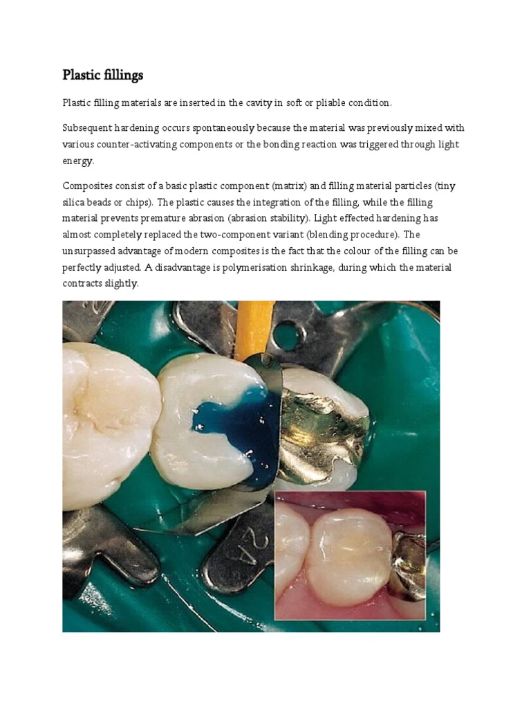 Plastic Fillings PDF