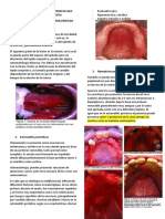 Enfermedades Bucales Relacionas Con Prótesis Removible