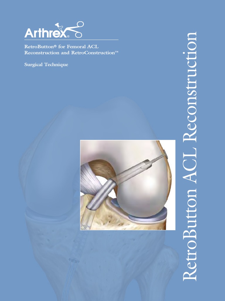 Arthrex RetroButton® For Femoral ACL | PDF | Surgery
