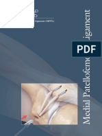Medial Patellofemoral Ligament (MPFL)