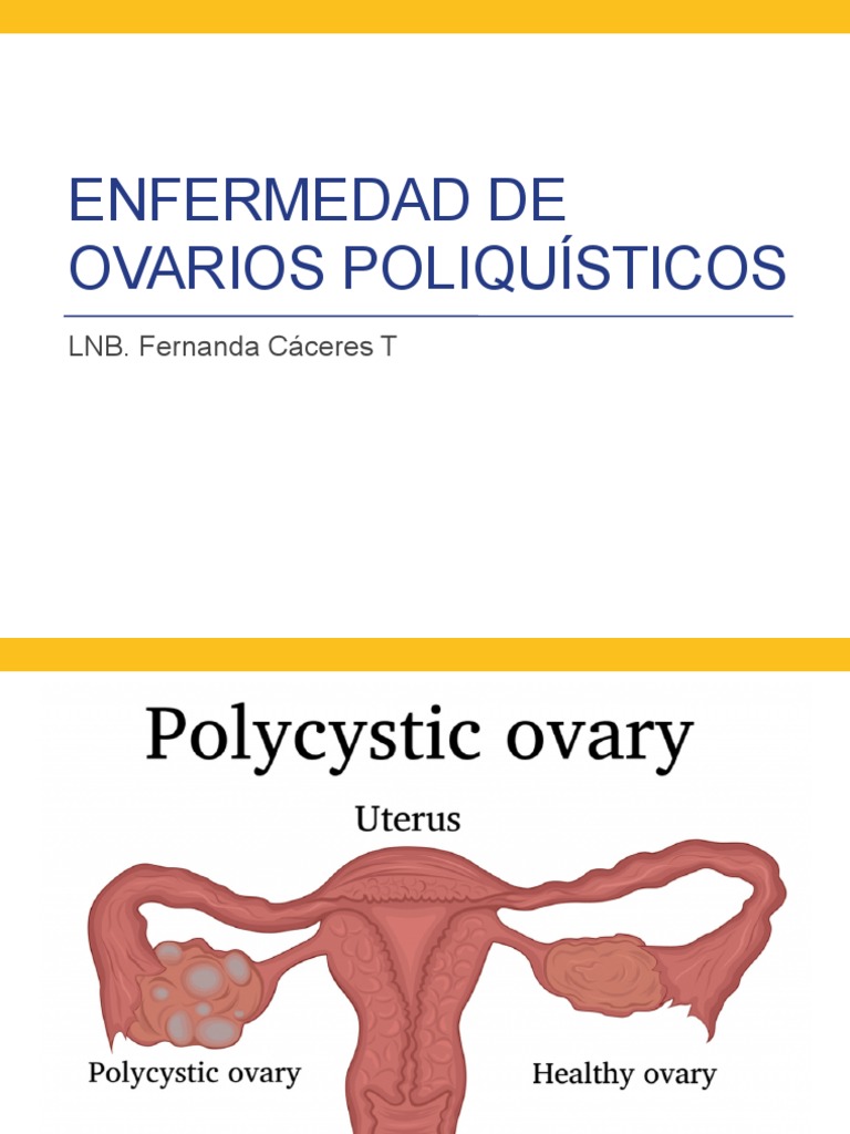 Síndrome de Ovarios Poliquísticos: Guía Completa | PDF | Síndrome ...