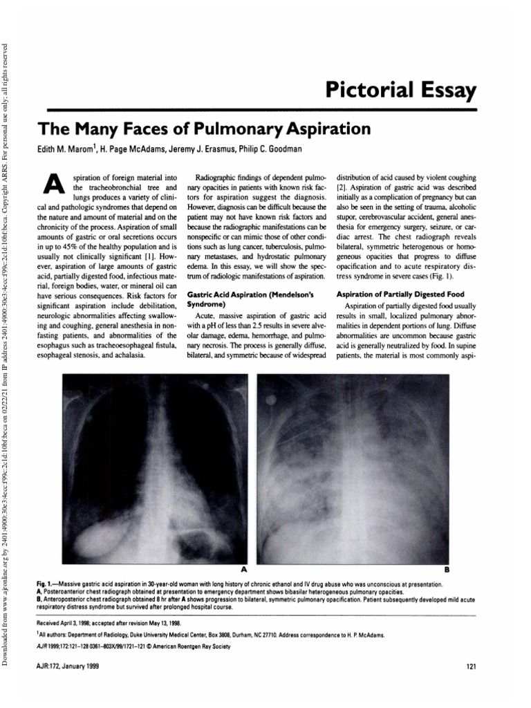 Aspirations PDF Pneumonia Epidemiology