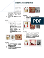 G.V. Blacks Classification of Caries