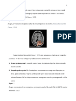 Meningioma