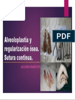 Alveoloplastía y Regularización Ósea