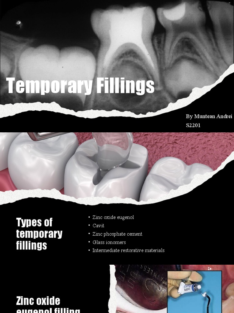 Temporary Fillings 319871 PDF