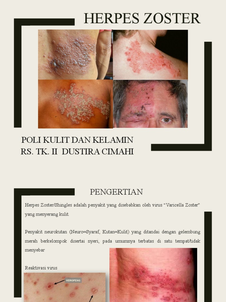 Panduan Herpes Zoster dan Pengobatannya | PDF