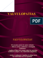 Valvulopatias Mitrales