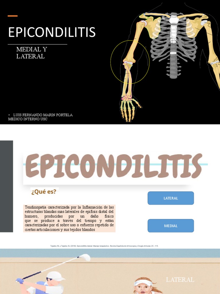 Epicondilitis | PDF | Sistema musculoesquelético | Medicina CLINICA