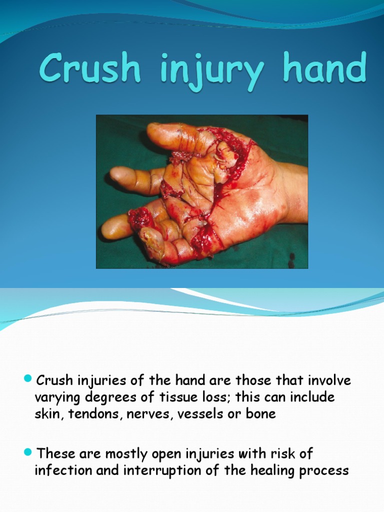 Crush Injury Hand PDF Injury Wound