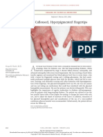 Calloused Hyperpigmented Fingertips