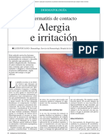 Dermatitis de Contacto Alergia e Irritacion