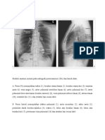 Struktur Anatomi Normal Pada Radiografi Dada PA dan Lateral