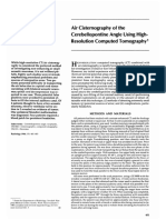 High-Resolution CT/Air Cisternography for Investigating Cerebellopontine Angle Acoustic Neuromas