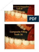 Class V Cavity Preparation Tooth