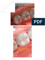 Class I Tooth Restorations Guide