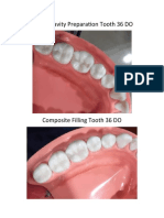 Class II Cavity Preparation Tooth