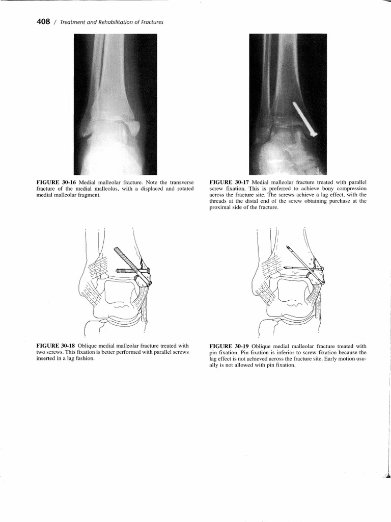 Ankle Fracture Treatment Protocol | PDF
