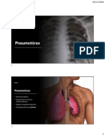 Pneumotórax: classificação, etiologia, mecanismo e tratamento