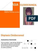 Displasia Cleidocraneal