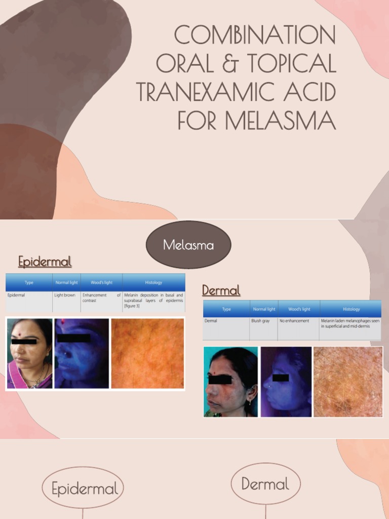 Tranexamic Acid Treatment For Melasma PDF