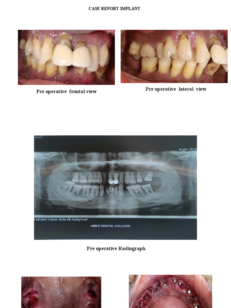 Case Report Implant | PDF