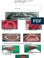 Case Reports 1- (Rehabilitation of a completely edentulous  mouth by  ALL ON 4 FIXED prosthesis    -A Case Report-1