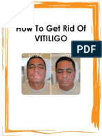 How To Get Rid Of Vitiligo Naturally