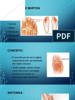 Neuroma de Morton