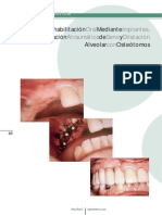 Rehabilitacion Oral - Implantes