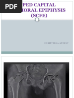 Slipped Capital Femoral Epiphysis (Scfe)