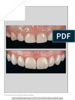 A Simplified Approach For Restoration of Worn Dentition Using The Full Mock