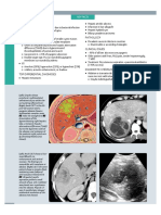 03 CT Absceso Piogeno Hepatico