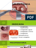 AMIGDALECTOMIA