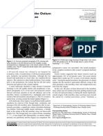 La Foreign Body in The Ostium