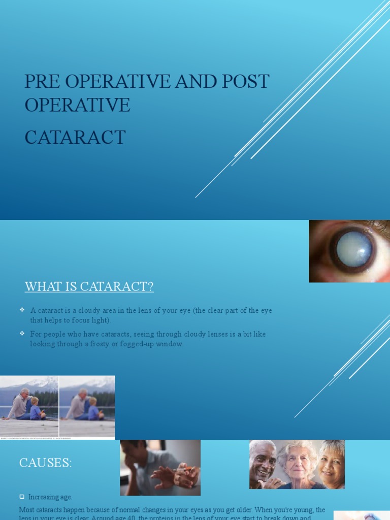 Pre Op And Post Op Cataracts Pdf Cataract Eye