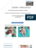 Gastrosquisis VS Onfalocele