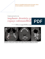 Complicações Cirúrgicas Na Mandíbula - Deslocamento de Dentes, Danos Neurais (Parestesia), Fraturas de Mandíbula, Coronectomia e Alveolite..odt