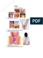 Chẩn đoán điều dưỡng về bệnh trĩ